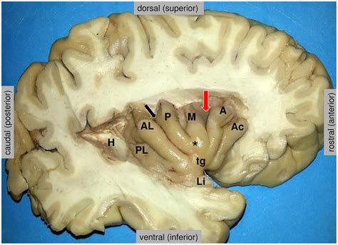 Anatomy Of The Insula As Disclosed In The Depth Of The Lateral
