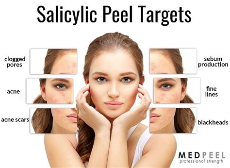 Salicylic Acid 20 Chemical Peel Cosmetic Surgery Tips