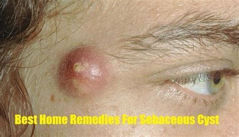 Best Home Remedies For Sebaceous Cyst Ehealthytip Natural Remedies