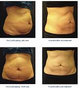 How Many Coolsculpting Treatments Are Needed Images