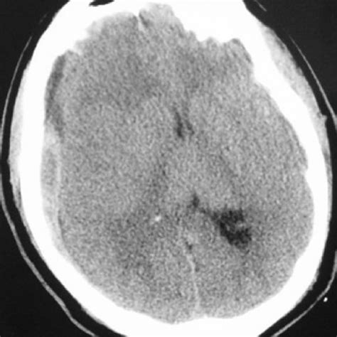 Acute Subdural Hematoma On The Right With Midline Shift Not