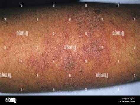 Nummular Eczema On Patients Arm Eczematous Dermatitis Stock Photo Alamy