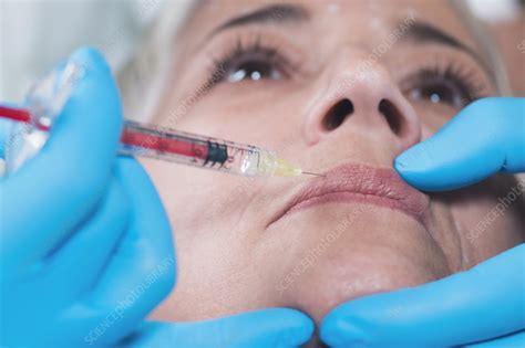 Woman Having Hyaluronic Acid Injections Stock Image F024 5253 Science Photo Library