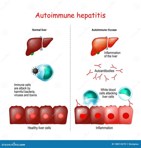 Hepatitis Autoinmune Ilustración Del Vector Ilustración De Vector