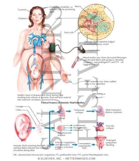 amniotic fluid embolism amniotic fluid nursing tips nurse