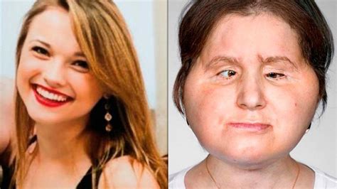 Impactantes Fotos Así Quedó La Mujer Más Joven En Recibir Un Trasplante De Rostro