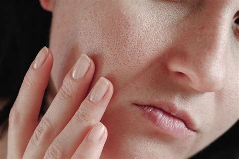 Enlarged Pores Skin Treatment Silk Laser Clinics