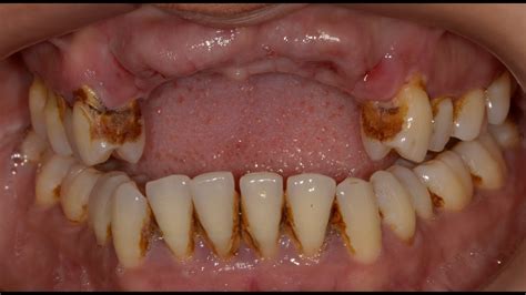 Teeth Falling Out Due To Gum Disease Teeth Poster