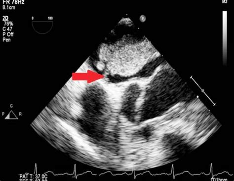 Unusual Presentation Of Left Atrial Myxoma Bmj Case Reports