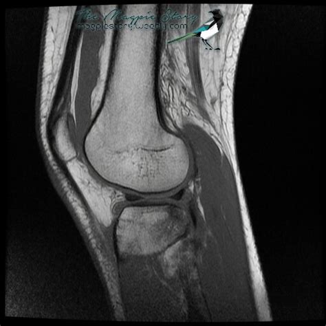 Check spelling or type a new query. MRI wonders - The MagpieStory - ACL Tear and Recovery