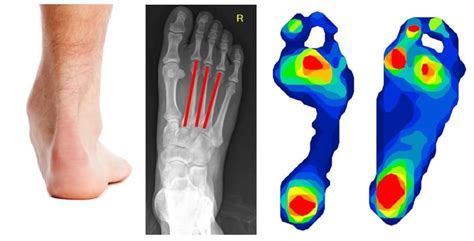 Types Of Foot Osteoarthritis Explained Stride