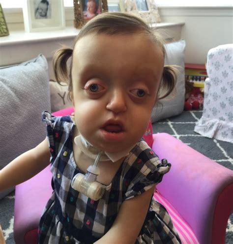 A Girl Born With A Severely Deformed Head Smiles In Spite Of Strangers Labeling Her An Alien