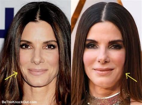 Sandra Bullock Plastic Surgery Comparison Photos