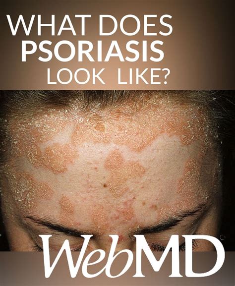41 Best Images About Psrioriasis And Skin Issues On Pinterest Crabs
