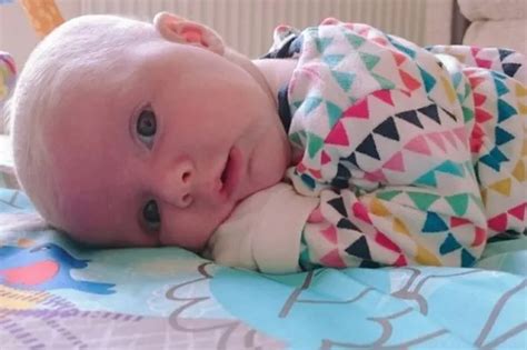 Parents Of Baby With Severe Flat Head Syndrome Say Thank You As