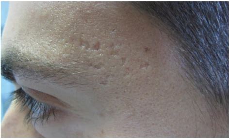 Acne Scar Removal And Treatment Austin Texas Ctd