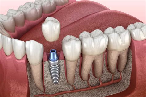 What Is A Single Tooth Implant Dental Implants Texas