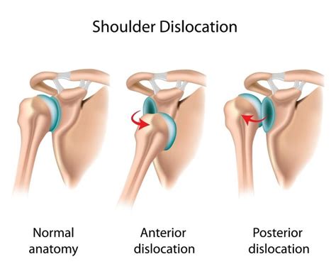 Shoulder Dislocation Dubai Sports Orthopaedics
