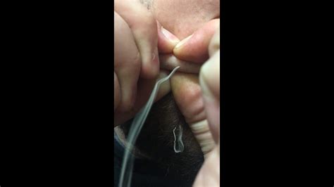 Insane Pimple Pop Huge Puss String Youtube