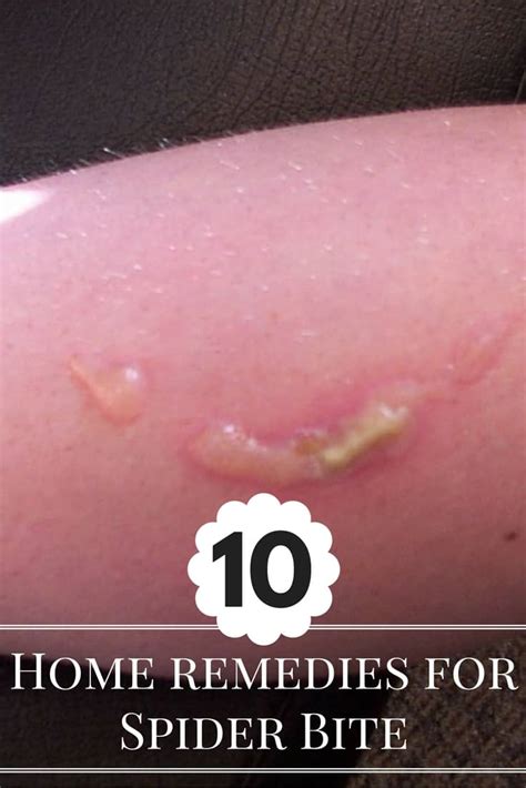 10 Natural Home Remedies For Spider Bite Treatment