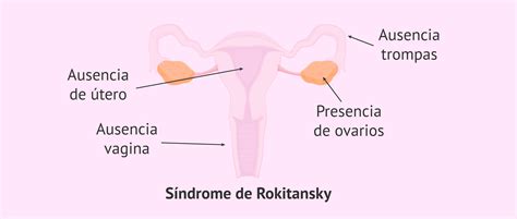 ¿qué Es El Síndrome De Rokitansky