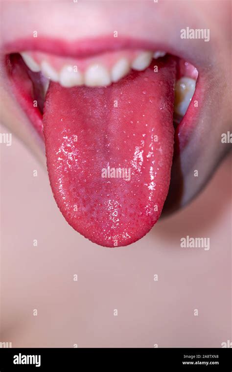 Scarlet Fever Tongue Hi Res Stock Photography And Images Alamy