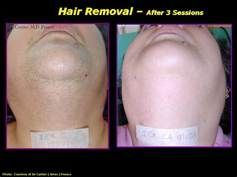 Ipl Hair Removal Before And After Estetika Aesthetic Clinic Norwich
