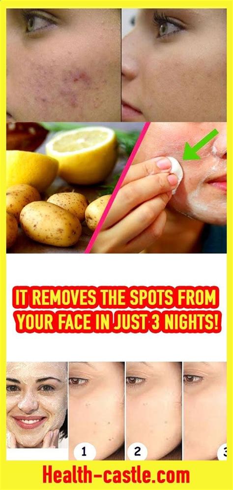 Removes All Spots On Your Face In Just 3 Nights Natural Health Tips