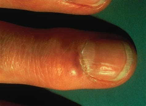 Myxoid Cysts Health Nails Magazine