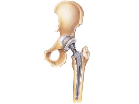 Hip Replacement Procedure Symptoms Types Of Implants And Risks