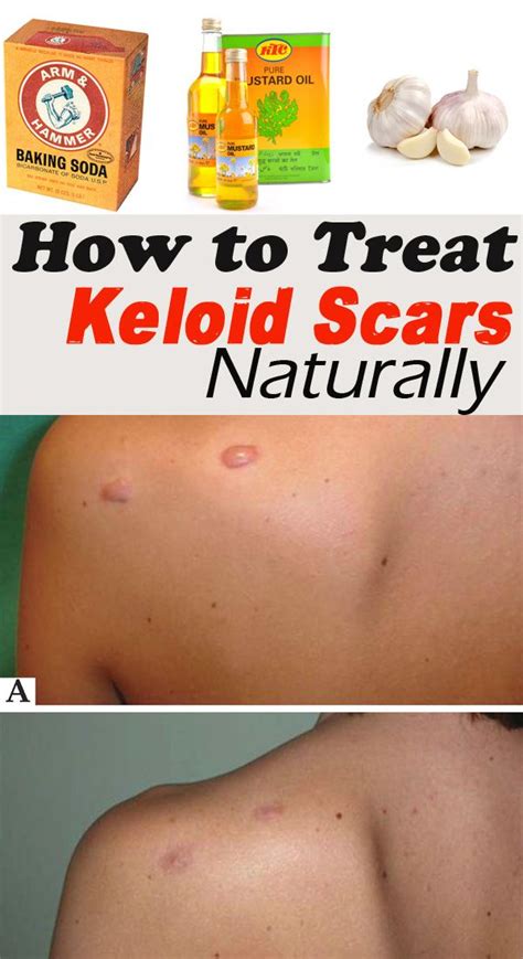 How To Treat Keloids Home Remedy Ho Modulartz