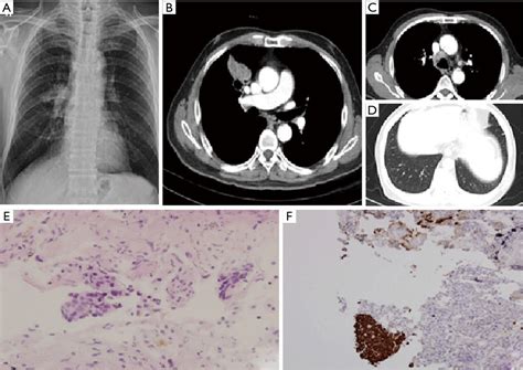 Spontaneous Regression In Advanced Squamous Cell Lung Carcinoma Park