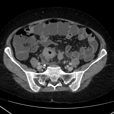 Colon Cancer Detected By Ct Scan Ct Scan Machine Images