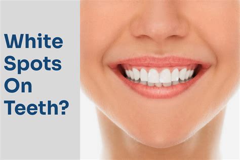 What Causes White Spots Teeth Dentaldost