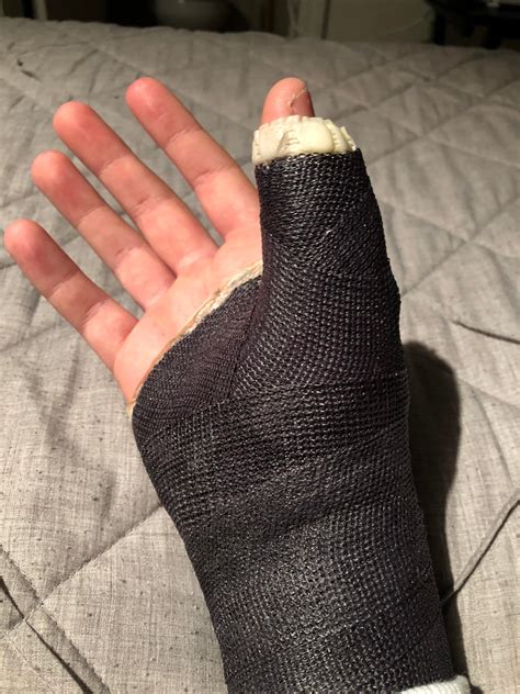 Broke My Hand A Week Before Rdr2 Reddeadredemption