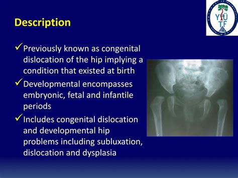 Ppt Developmental Dysplasia Of The Hip Powerpoint Presentation Free