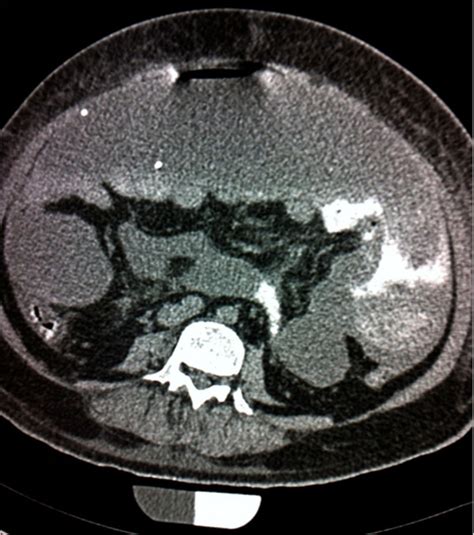 Emergent Axial Computed Tomography Scan Of The Abdomen With Contrast