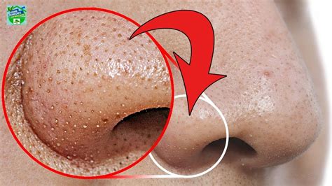 Do This To Remove Blackheads From The Nose At Home In 5 Minutes Or Less