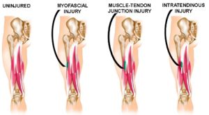 Find out how they're caused, diagnosed, treated, and prevented. Hamstring injuries: why location and anatomy matters!