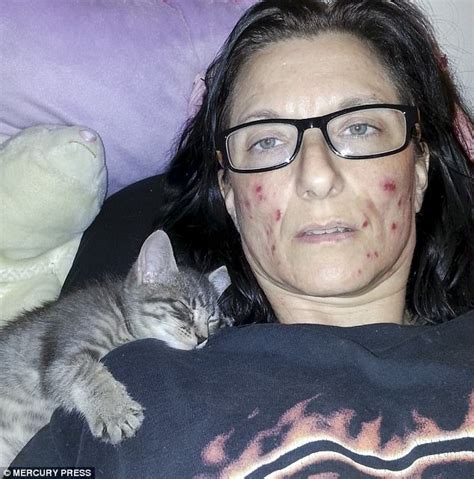 Mom With Dermatillomania Wants To Be Put In A Coma Daily Mail Online
