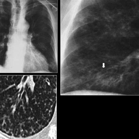 Pneumocystis Carinii Pneumonia Atypical Features Chest X Ray Shows