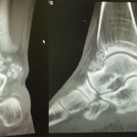 Anteroposterior And Lateral Left Ankle Radiographs Show Calcified Loose