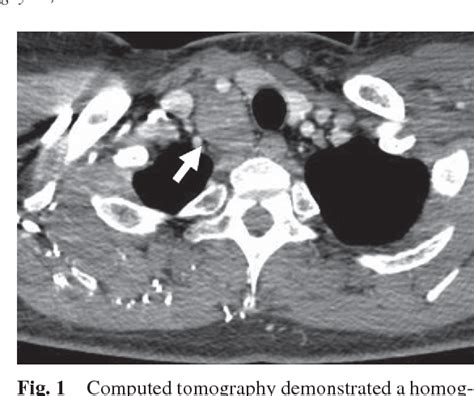 Figure 1 From Ectopic Cervical Thymoma Accompanied By Goods Syndrome