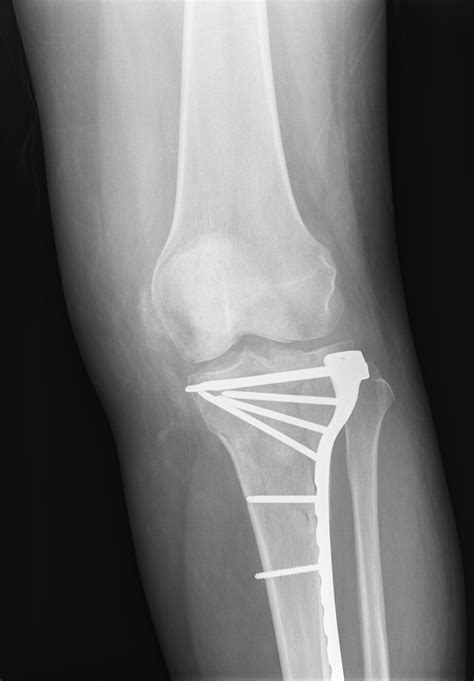A tibial plateau fracture is a break of the upper part of the tibia (shinbone) that involves the knee joint. UCSD Musculoskeletal Radiology