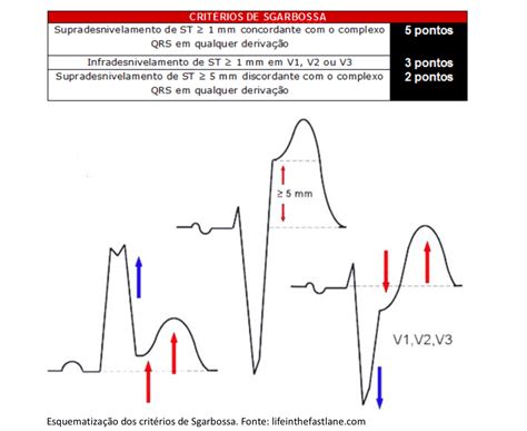Ecg Bloqueio De Ramo