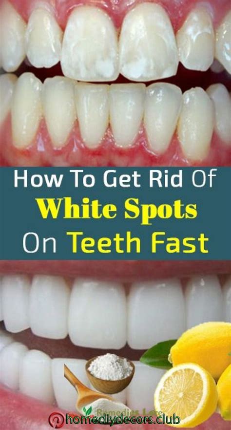 How To Get Rid Of White Spots On Teeth Fast Ta Simple Smile On Our Face