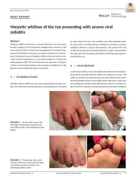 Pdf Herpetic Whitlow Of The Toe Presenting With Severe Viral