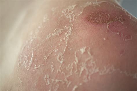 Skin Peeling A Healing Step Or Reason To Worry