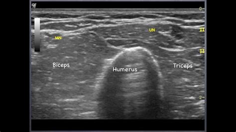 Ulnar Nerve Elbow Ultrasound Images And Photos Finder