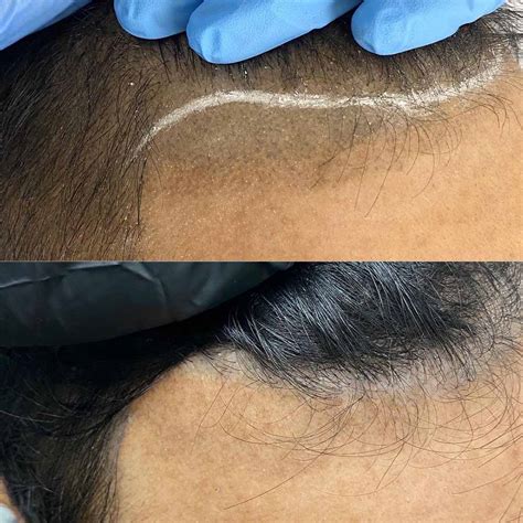 Scalp Micropigmentation Removal Everything You Should Know